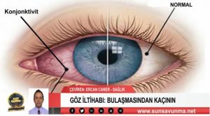 GÖZ İLTİHABI: BULAŞMASINDAN KAÇININ