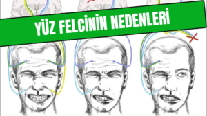 Yüz Felcinin Nedenleri